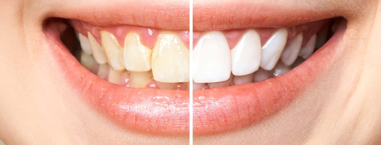 Metamorfoza wybielania zębów efekt przed i po