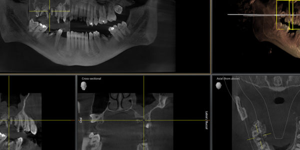 Tomografia komputerowa szczęki żuchwy