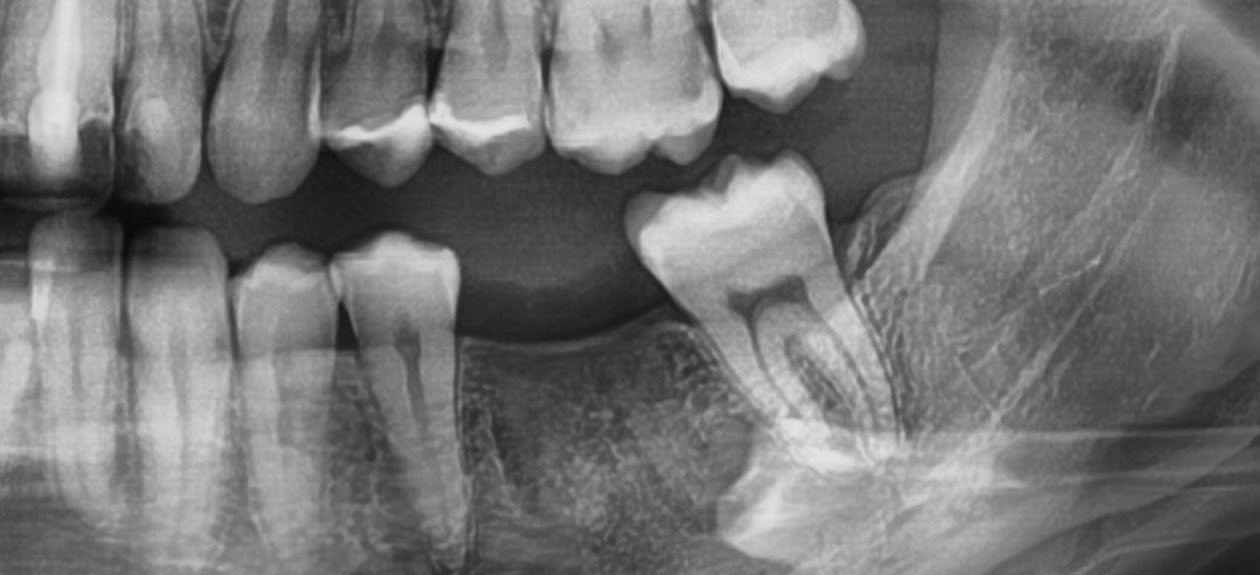 Zdjęcie rentgenowskie braku zębowego