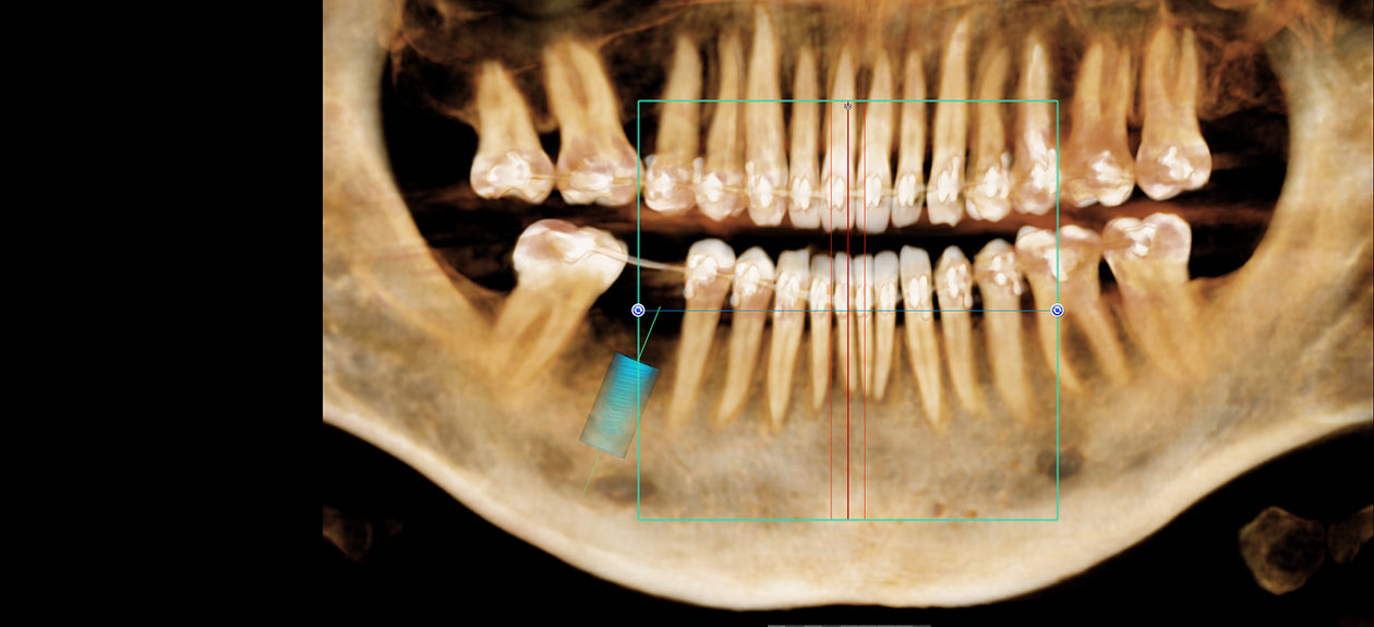 Projekt wszczepienia implantu przez lekarzy w Dental Fraternity