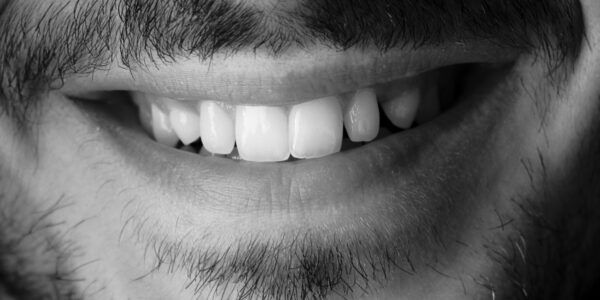Niepróchnicowe ubytki tkanek twardych zęba &#8211; abrazja, atrycja, erozja, abfrakcja