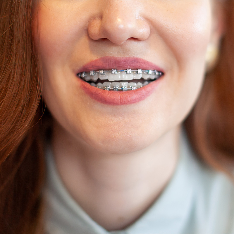 aparat ortodontyczny