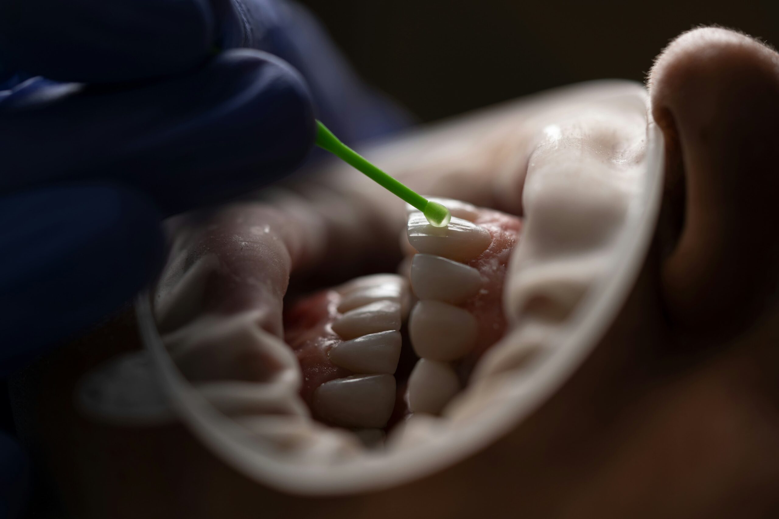 Leukoplakia