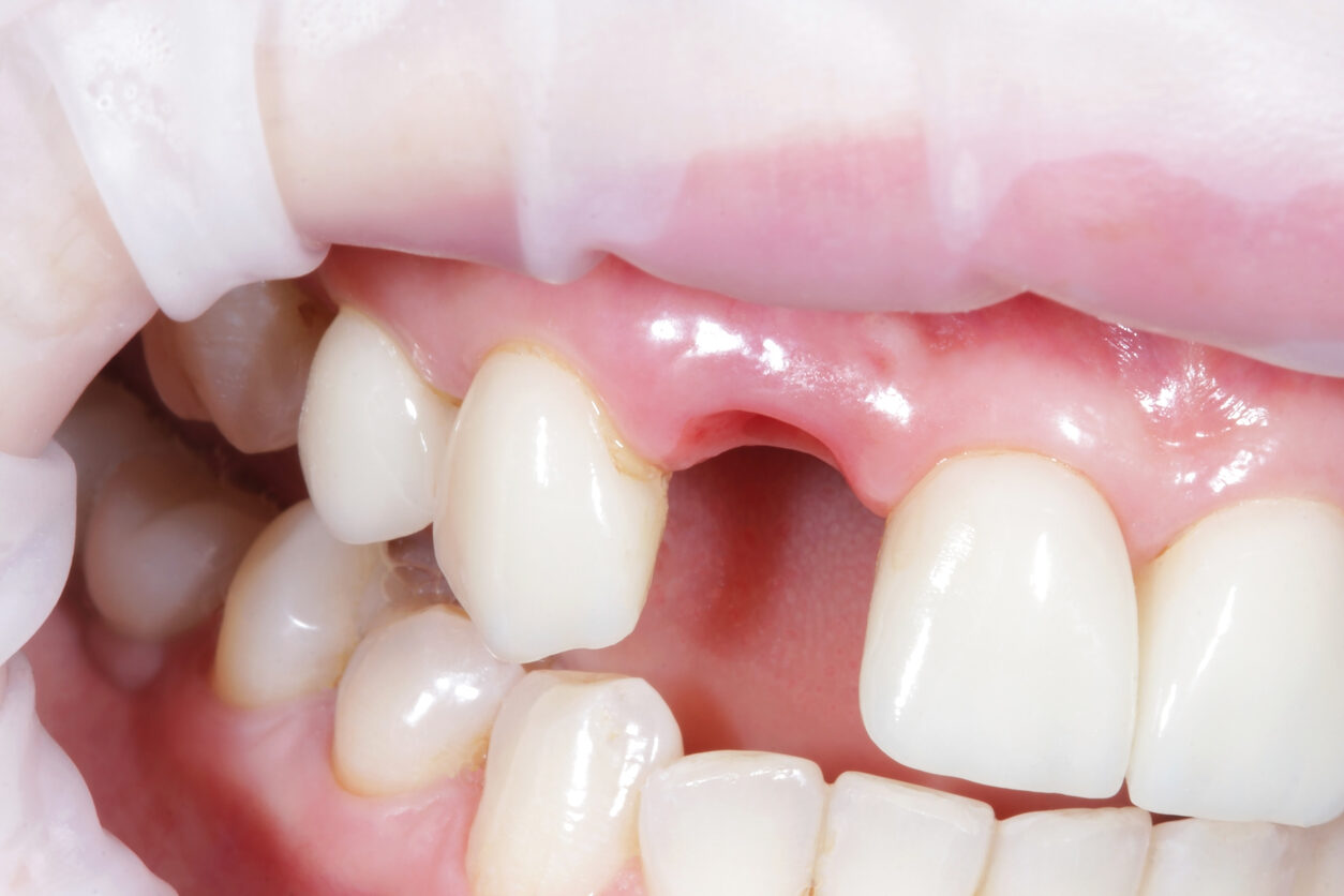Braki zębowe &ndash; dlaczego ich uzupełnienie jest kluczowe dla zdrowia i komfortu życia?