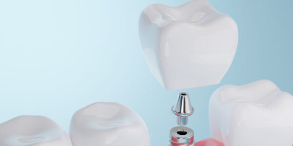 Jak dbać o higienę jamy ustnej po wszczepieniu implant&oacute;w?