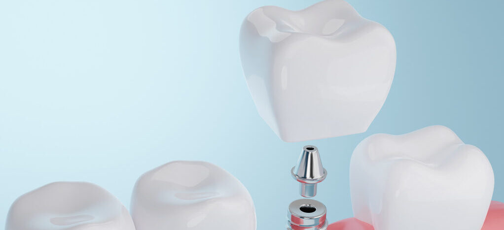 Co to wkład koronowo-korzeniowy?