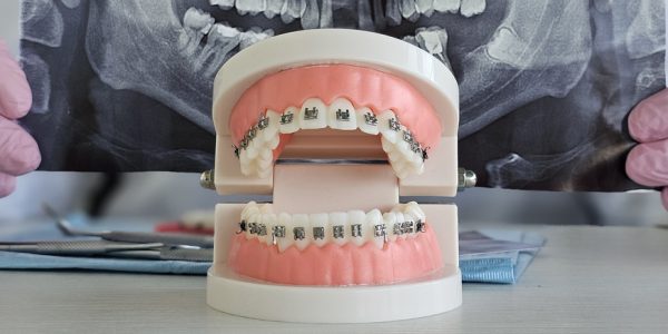 Czy zakładanie aparatu boli?