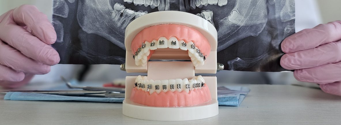 Kiedy jest za p&oacute;źno na aparat ortodontyczny?